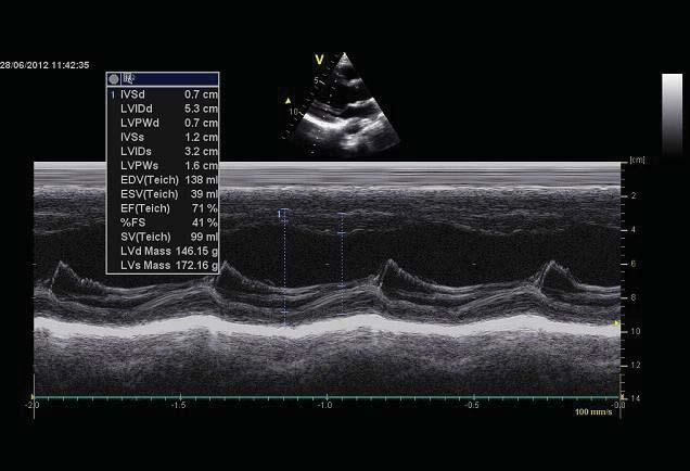 Maximální LVMI 54,4 g/ m 2,7, po operaci definitivní LVMI 35,2 g/m 2,7. Na obrázcích echokardiografie zlepšení parametrů LK.