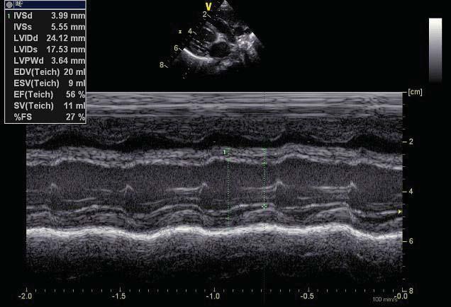 712 Echokardiografické hodnocení srdeční struktury a funkce u dětí s hypertenzí LVMI g/m g / m 2,7 2,7 80 70 60 40 30 20 Zahájení terapie Zahájení terapie Chlapci: percentily LVMI 99 95 75 25 5 0 0 1