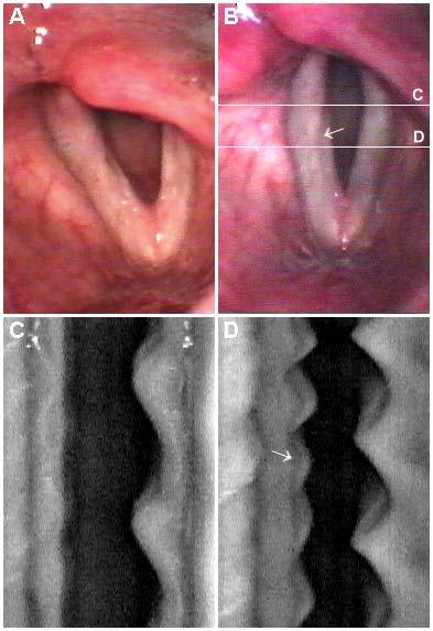 (B): Fáze maximálního otevření glottis při fonaci. (C): Dýchání - laryngoskopický nález.
