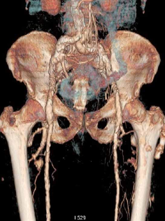 The control CT exam showed reduction in size of the hematoma and patent lumen of left superficial femoral artery, that was no more compressed and dislocated (Fig. 5).