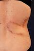 Imunoterapie metastazujícího melanomu