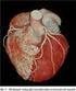 Ischemická choroba srdeční a její detekce