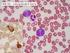 Neoplazmata z B a T/NK buněk jsou klonální tumory zralých nebo nezralých B-buněk, T- nebo NK-buněk v různých stádiích diferenciace