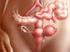 Karcinom vaječníků. Avastin v léčbě karcinomu vaječníků - východiska a klinické studie
