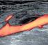 Výduť podkolenní tepny (aneuryzma popliteální arterie)