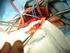 Duální antiagregace u pacientů po chirurgické revaskularizaci myokardu