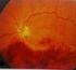 Váš průvodce léčbou poškození zraku způsobeného makulárním edémem v důsledku okluze retinální žíly (RVO) přípravkem Lucentis (ranibizumab)