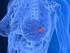 Prevence rakoviny prsu Prevention of breast cancer
