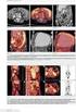 Ferdová E, Ferda J, Malán A, Zedníková I, Ňaršanská A, Ondřej H. Předoperační hodnocení N-stagingu karcinomu prsu pomocí 18 F-FDG-PET/CT