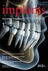 12017 české vydání. international magazine of oral implantology. Výzkum Implantát v místě horního laterálního řezáku