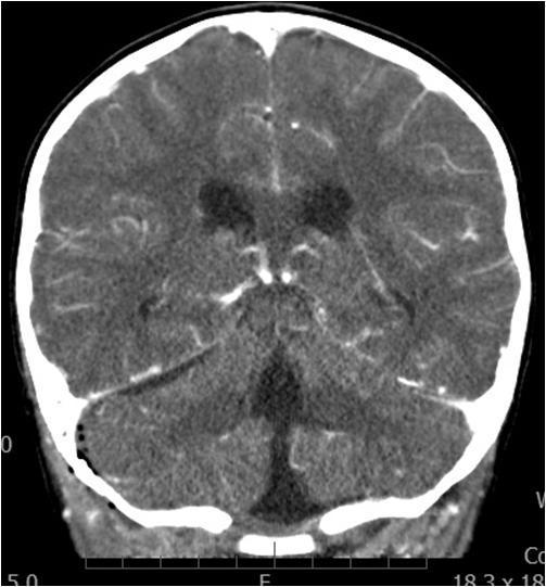4-letý chlapec s meningeálními příznaky, septický otitis, zvětšené mandle, kariézní chrup CT a MRI hlavy: