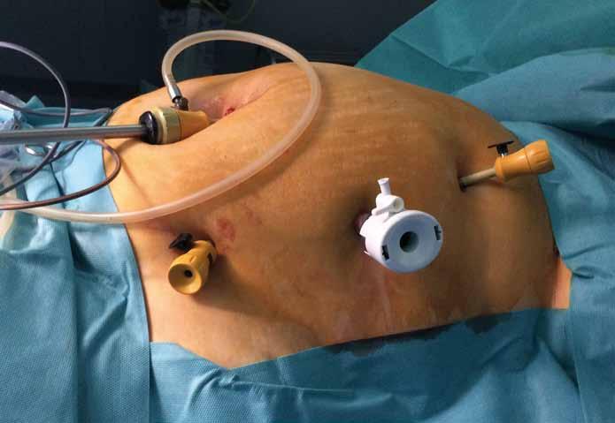 Parciální jejunální diverze Hereditárny technické angioedém aspekty ako a príčina počáteční bolestí zkušenosti brucha Úvod Chirurgie závažné obezity je známá již desetiletí pod pojmem bariatrická