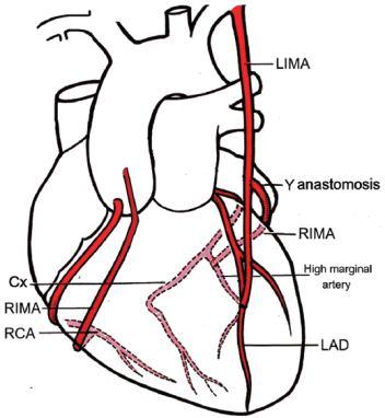 News The additiona important arteries of the body which are used in the Coronary Arteria Bypass surgery In today's day and age, diseases of the coronary arteries are one of the eading causes of