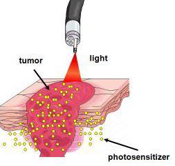 Lasers in Cancer Treatment The word LASE stands for Light Ampification by Stimuated Emission of adiation. Laser ight is different from reguar ight.