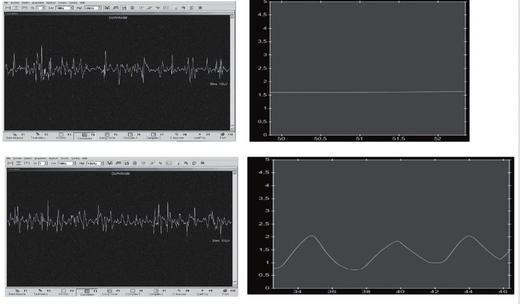 4.4 Výsledky EMG vyšetření Při EMG vyšetření byly během inspiria zaznamenány potenciály s amplitudou do 250 μv (obr. 26).