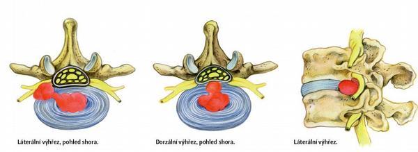 Obecná část degenerace pokročilá, fragment nemusí obsahovat jen část nucleus pulposus, ale i částečky anulus fibrosus. Fragment vyhřezává buď ve vertikálním směru, tj.