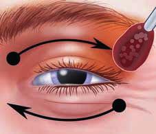 This procedure shouldshould be permed by a by a ould be observed tray assembly, anaestic preparation, preparation drug preparation administration.