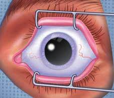 In addition outlined your specific on outlined below, of your specific wed. Aseptic technique should be observed during tray assembly, anaestic preparation, drug preparation administration.