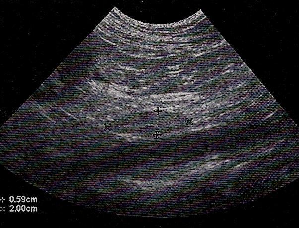 Ad 2) Ultrazvukem je možné detekovat případné změny v orgánech, kam nejčastěji směřují případné metastázy.