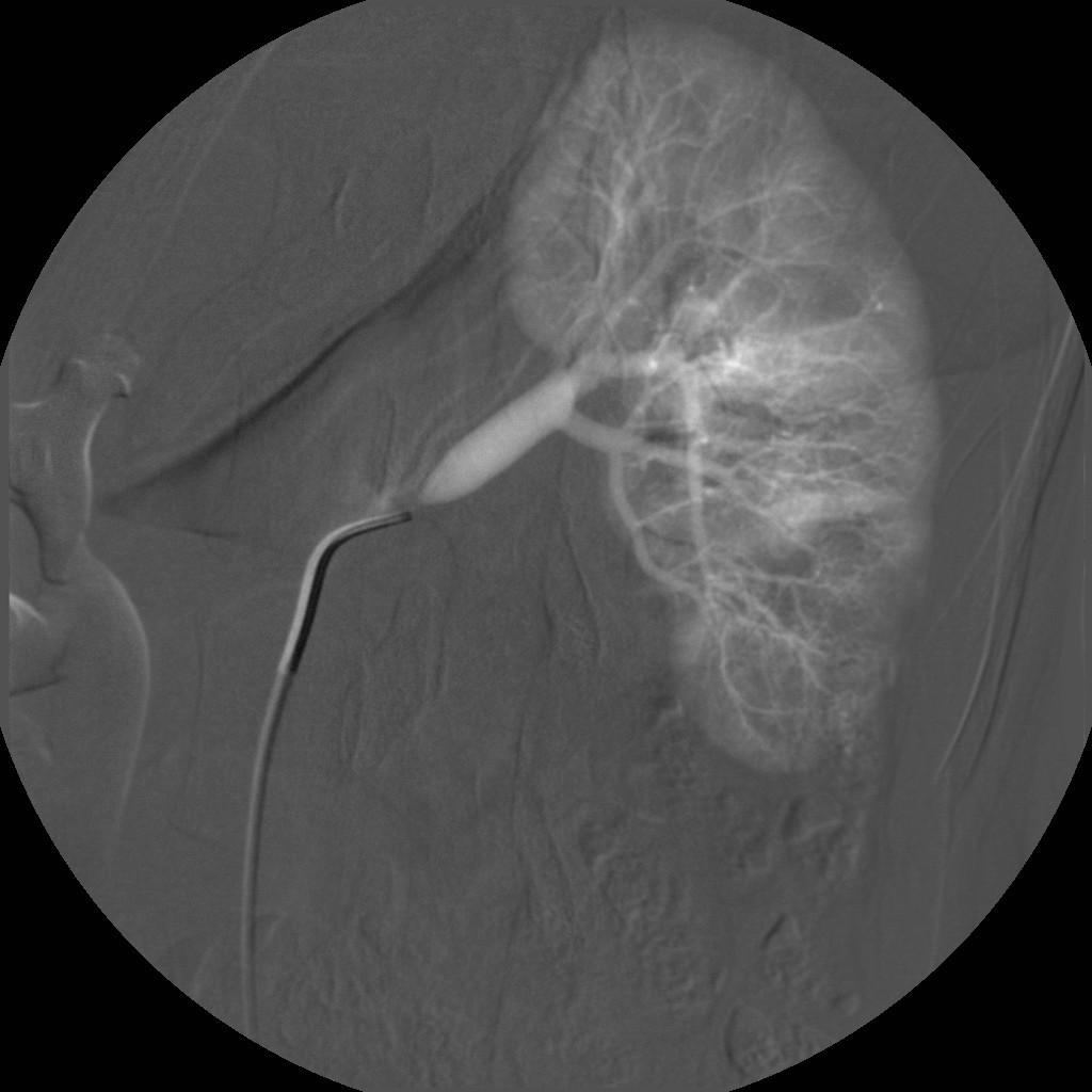 Příloha II Obrázek 1: Angiografie levé renální tepny: nasondování ústí ledvinné tepny cévkou Pacient: