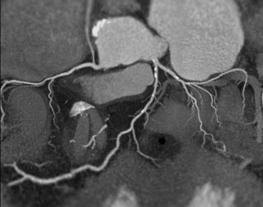 Reliability of the method Segments with worse image quality: 16 channel studies 2004-2005: 6-7% 64 channel studies 2006: 3% 64 DSCT 2008: 2% ict 2008: ~ 1% Segments Vessels Patients Non-diagnostic