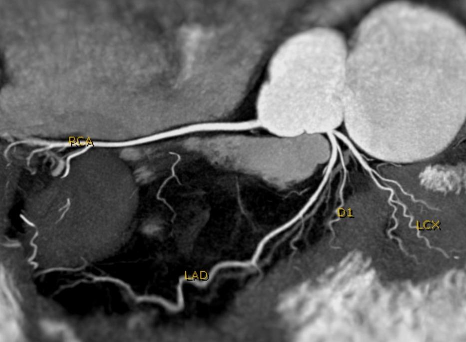 64 Coronary angiogram 2-D-map acquired with ict