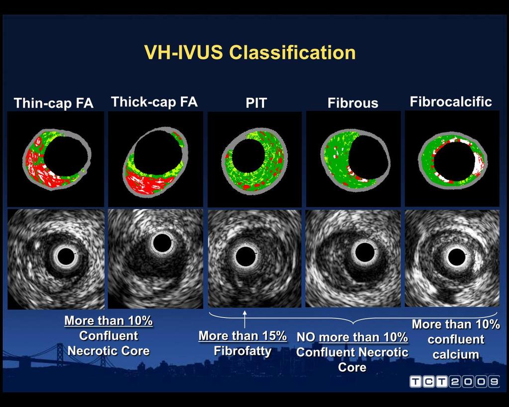 IVUS