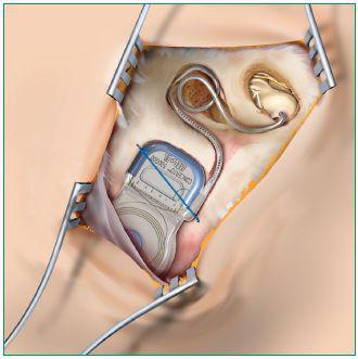Obrázek 3: vnitřní část kochleárního implantátu Zdroj: http://www.audionika.cz 5.