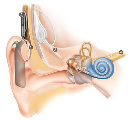 Příloha 5: Edukační leták KOCHLEÁRNÍ IMPLANTÁT Co to je? Druh ušního implantátu Vkládá se operační cestou do vnitřního ucha Nahrazuje funkci vnitřího ucha Komu je určený?