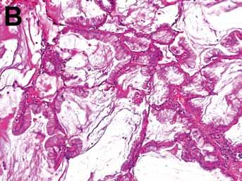 podél stěny alveolů bez invaze do stromatu adenokarcinom in situ adenokarcinom velikosti do 3 cm s lepidickým růstem, mucinózní i nemucinózní minimálně invazivní minimálně invazivní adenokarcinom