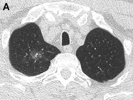 Obr. 2A Obr. 2B Obr. 2. Adenokarcinom in situ. Muž, 71 let, nekuřák, po levostranné hemikolektomii pro adenokarcinom a po levostranné nefrektomii pro tubulocystický karcinom.