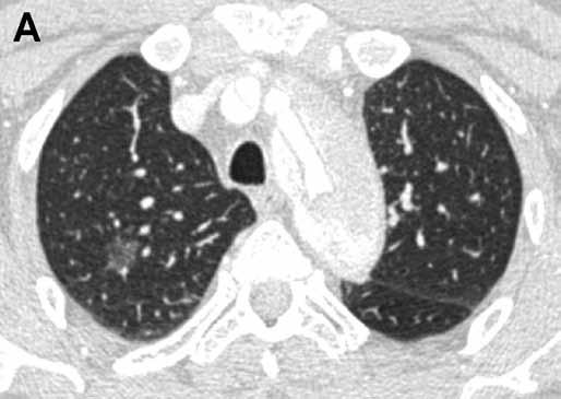 In the dispensary CT examination, a ground glass node without solid component was detected in the right upper lobe. A axial plane; B coronal plane. The finding was stable for 2 years.