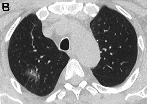 U invazivních variant, které mají horší prognózu, solidní složky přibývá, mohou rovněž vytvářet konsolidace připomínající pneumonii nebo multifokální či difuzní postižení podobné intersticiálním