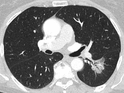 64-year-old man, former smoker with chronic obstructive bronchopulmonary disease. Subsolid nodue in right upper lobe with fried egg pattern. There is a small pseudo-cavitation in the center. Obr. 5.