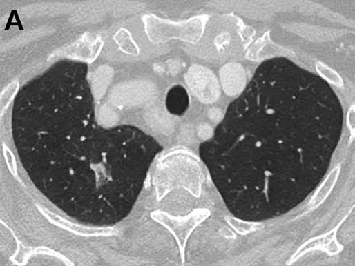 Fig. 5. Non-mucinous adenocarcinoma with predominantly lepidic growth. 68-year-old woman, non-smoker.