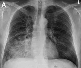 A 56-year-old woman admitted to hospital for suspicion of pneumonia.