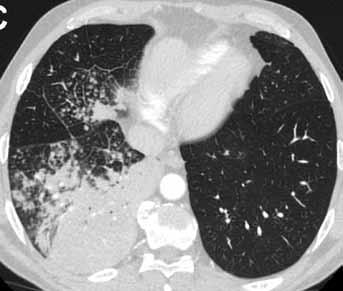 At 1-month follow-up radiograph revealed only slight regression of the finding.
