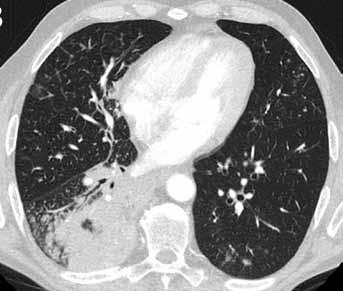 CT in the axial (D) and sagittal plane (E) reveals middle lobe consolidation with air-bronchograms and ground glass