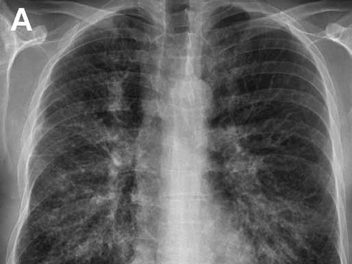 Obdobný nález je vidět na CT ze stejné doby, rozsev uzlů má tendenci k peribronchiální distribuci (E). Fig. 9. Mucinous adenocarcinoma with predominantly lepidic growth.