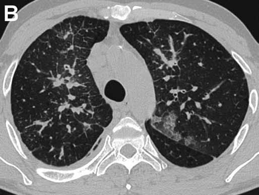 CT shows consolidation with negative bronchograms and angiograms. In close proximity there is a bronchus with thickened wall and centrilobular nodules (B).