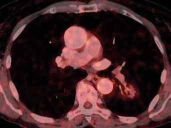 42-year-old man, a former smoker, with worsening dyspnea after respiratory infection.