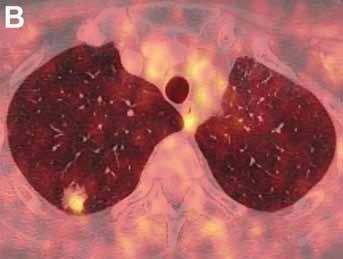 On axial CT images at different levels, there is irregular bronchial wall thickening, ground glass opacity areas, and interlobular septal
