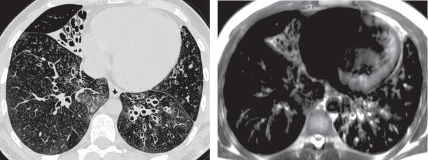 Chronická onemocnění plic dětí a mladých dospělých Transverse HRCT (a) and transverse MR (b) images from an 18-year-old male with recurrent pneumonia.