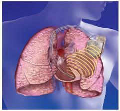 Impedance Fluid Index Existují různé senzory, které dávají informaci o srdečním selhání Suché plíce