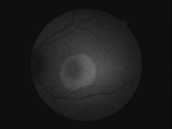 rochin, imunosupresiva: methotrexát, azathioprin, mykofenolát mofetil, u těžké glomerulonefritidy a závažných orgánových komplikací cyklofosfamid), dále kortikoidy a intravenózní imunoglobuliny.