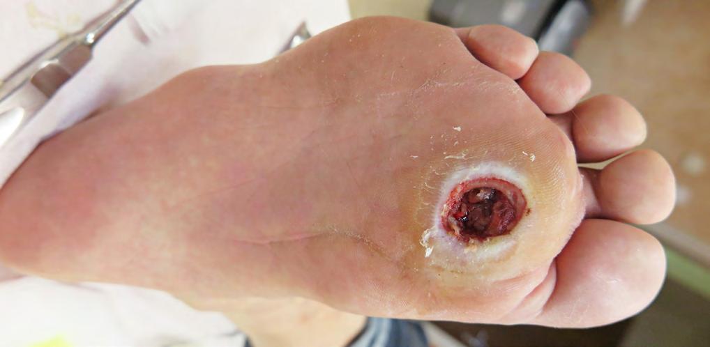 z Závažná neproliferativní a neošetřená proliferativní retinopatie (obr. 5) jedinci s tímto postižením jsou ohroženi krvácením do sklivce a postižením sítnice.