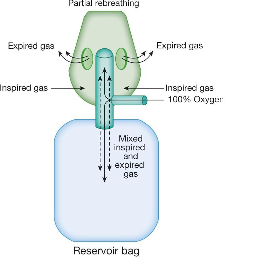 S částečným zpětným vdechováním dokud rychlost výdechu neklesne pod rychlost příkonu čerstvé směsi jde vydechované směs do rezervoáru - jedná se o první část vydechovaného objemu, tzn.