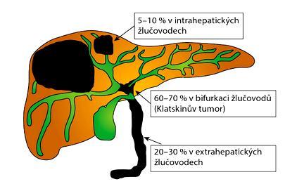 Mezi rizikové faktory vzniku tohoto karcinomu patří kongenitální onemocnění žlučových cest, hepatolitiáza, především v oblasti Japonska a jihovýchodní Asie a parazitární onemocnění.