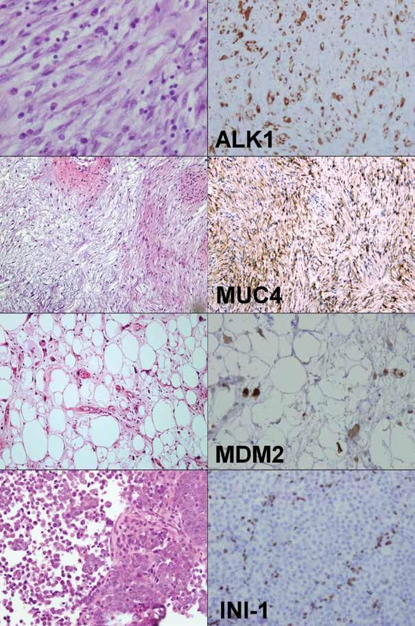 Obr. 2 Výběr protilátek užitečných v diagnostice nádorů měkkých tkání Inflamatorní myofibroblastický tumor pozitivní v průkazu ALK1, low-grade fibromyxoidní sarkom