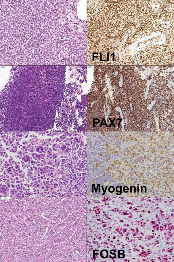 Obr. 3 Výběr protilátek užitečných v diagnostice nádorů měkkých tkání Ewingův sarkom exprimující FLI1, Ewingův sarkom s